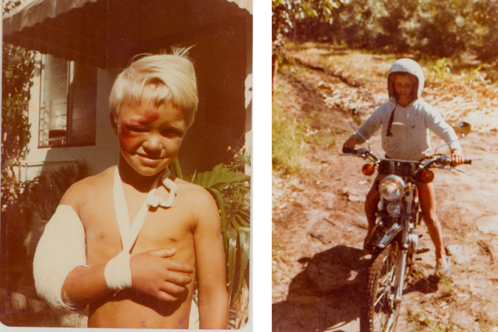Childhood photos of Ant Smyth after injuring his right arm and riding a motorcycle.